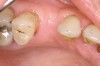 Figure 4  Clinical photograph showing preservation of the ridge seen in Figure 3.