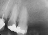 Figure 5  Recurrent decay of teeth Nos. 11 and 12. Note the proximity of the decay on both teeth to the osseous crest.