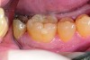 Fig 4 and Fig 5. Occlusal (Fig 4) and buccal (Fig 5) 42-month recall views of the Class I and Class V GIC restorations placed with bulk-fill EQUIA technique.