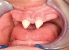 Figure 4  Pretreatment frontal view of the dental arches. Note the classic cone-shaped maxillary incisors..