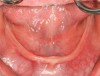 Figure 5  Mandibular alveolar ridge shows a knife-edged appearance.