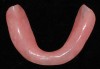 Figure 10  Heat-processed mandibular record base.