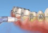Figure 10 Specialized orthodontic tip with tapered bristles. Tip is used to deliver pulsating lavage to clean interdentally, subgingivally, and on the tooth surfaces (Fig 10). Bristles can be used to clean and brush around the brackets and archwires while