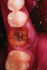 Fig 8. Case 2: Hopeless mandibular first molar prior to extraction.
