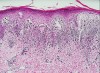 Figure 4  Histograph of lichen planus. Note the saw-tooth rete pegs.