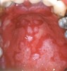 Figure 5  Oral presentation of GVHD.