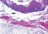 Figure 9  Histograph of MMP. The arrow shows epithelium separation.