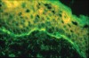 Figure 10  Direct immunofluorescence findings of pemphigoid.