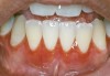 Figure 12  Oral presentation of PV on the gingival.