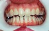 Figure 8  Prior to at-home whitening. Following approximately 10 days of at-home tray whitening.