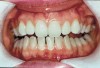Figure 9  Prior to at-home whitening. Following approximately 10 days of at-home tray whitening.
