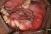 Figure 2  An infiltrating erythematous lesion displacing teeth and bone.