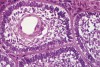 Figure 4  Histology consistent with the diagnosis of ameloblastoma.