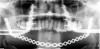 Figure 5  Panoramic radiograph shows a titanium reconstruction plate in place after tumor resection from left subcondylar region to the right angle of the mandible.