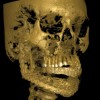 Figure 8  CBCT scan with the surgical guide to establish vertical dimension of occlusion below, which can be seen in the TBP and particulate bone fill.