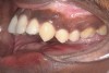 Figure 9  Dental protrusion with incisor irregularity and a dual plane of occlusion.