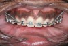 Figure 10  Nickel titanium coils were attached to TADs for incisor movement.