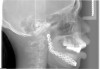 Figure 15  Cephalometric x-ray with a transitional prosthesis covered in barium sulfate.