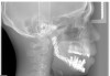 Figure 16  Cephalometric x-ray shows dental implants and a change in incisor positioning that creates an esthetic lip drape.