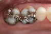 Figure 2  Preoperative occlusal view of teeth Nos. 2 and 3.