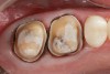 Figure 3  Gingival tissues have been retracted with cord in readiness for the digital impression.