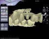 Figure 6  Digital models aligned in maximum intercuspation based on the buccal scan.
