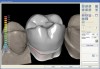 Figure 13  Final design of the digital veneer.