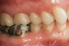 Figure 18  Facial view of the cemented crowns for teeth Nos. 2 and 3.