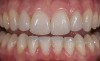 Figure 6  Two-year postoperative image of very conservative Category 1 bonded porcelain restorations.