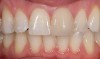 Figure 2a  Anterior porcelain veneer restoration.