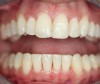 Figure 5   Final composite restorations of the four maxillary incisors.