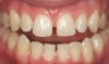 Figure 6  Multiple diastemas requiring closure to improve smile design.