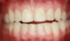 Figure 7  Diastema closure with composite.