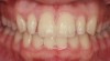 Figure 10  Retracted teeth showing peg lateral.