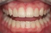 Figure 11  Retracted teeth showing restoration of peg laterals.