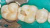 Figure 12  Restorative preparations gaining access and removing caries..