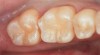 Figure 13  Final restorations.