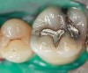 Figure 14   maxillary first molar with extensive caries around old amalgams.