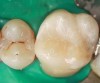 Figure 16  Final composite restoration following extensive layering to avoid the negative effects of shrinkage.