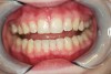 Figure 17  Teeth with small imperfections, including wear on the cuspids, wear and decalcification on the right central incisor, and a developmental groove on the incisal edge of the left lateral.