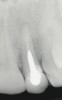 Figure 2  Periapical radiograph of lateral incisor shows periradicular radiolucency but suggests normal interdental bone levels.