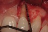 Figure 3  Surgical flap elevation reveals a 10-mm facial bony dehiscence.