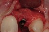 Figure 6  Alveolar ridge form permitted optimal implant placement (5 months posttreatment).
