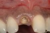 Figure 9  Maxillary right central incisor fractured below gingival margin.