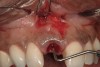 Figure 10  Submarginal flap elevation reveals apical concavity and associated fenestration defect.