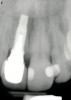 Figure 13  Postoperative findings were consistent with normal bone remodeling and implant integration.