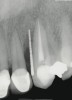 Figure 14  Periapical radiograph of fractured maxillary left canine with a calibrated point (15-mm markings) demonstrating extent of attachment loss on mesiobuccal aspect of the tooth. Similar probing was present on the distobuccal aspect of the tooth.