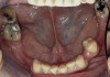 Figure 5  Intraoral occlusal view of mandibular dentition presenting excessive signs of wear.