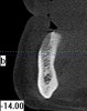 Figure 2  CT scan of the mandibular canal, relative to the expected location of implant placement. Inadequate bone in this region will address modification of the implant used, the need for osseous regeneration first, or in the most severe cases, possible contraindication for implant placement.