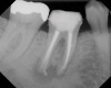 Figure 4  Clinical case of a lack of coronal seal that contributed to the failure of this root canal treatment.